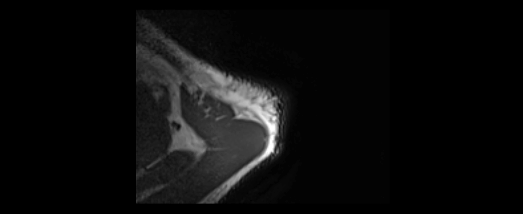 shoulder ligaments axial 3d 3t mri image-img-00005-00008.webp